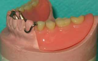 Алгоритм выбора опорных зубов для фиксации протезов