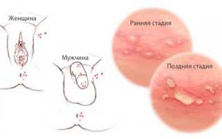 Внеклеточные диплококки в мазке у женщин и мужчин