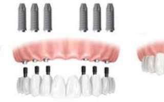 Имплантация All on 6 — возможность несъемного протезирования при полном отсутствии зубов за 1 день