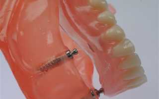 Термопласты Perflex для изготовления зубных протезов