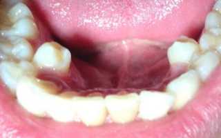Что такое сверхкомплектные зубы, и стоит ли от них избавляться?