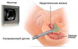 Подготовка к ТРУЗИ предстательной железы: как питаться и очистить кишечник