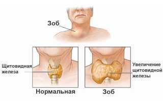 Симптомы и лечение диффузно-узлового зоба щитовидной железы