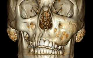 Насколько опасна дисплазия челюстей, и как от нее избавиться