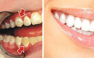 Как эффективно и быстро убрать зубной налет?