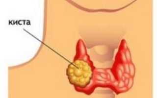 Фокальное изменение щитовидной железы на УЗИ: при каких заболеваниях можно выявить