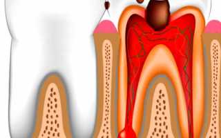 Можно ли сохранить зуб при гипертрофическом пульпите?