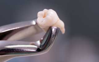 Какие есть способы остановить кровь после удаления зуба?
