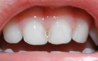 Кариес между передними зубами: особенности развития и терапия
