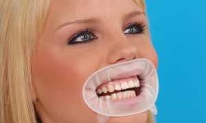 Оптрагейт в стоматологии – легко специалисту и комфортно пациенту