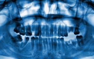 Можно ли делать рентген зуба при беременности, будет ли вред?