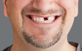 Все самое важное о способах протезирования после удаления зубов
