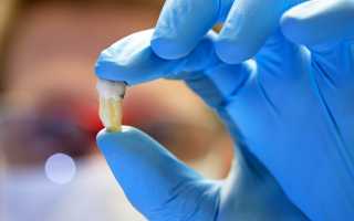 Что такое альвеолит после удаления зуба?