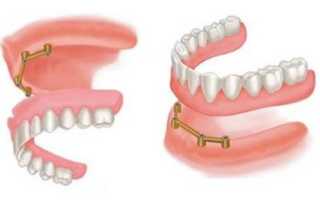 Балочный протез на имплантатах — бюджетное восстановление утерянных зубов