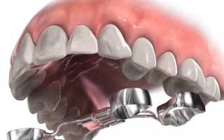 Особенности применения аппарата Норда в ортодонтии