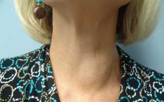 Киста щитовидной железы, опасно ли это?