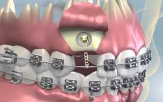 О целесообразности методики ортодонтического вытяжения зуба