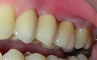 Из чего складываются цены на протезирование зубов металлокерамикой?
