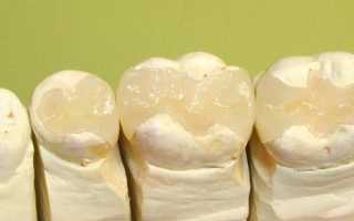 Что такое керамическая вкладка в зуб и как проводится микропротезирование?
