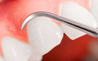 Эффективность применения цистэктомии для устранения кисты зуба