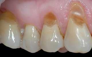 Клиновидный дефект зуба – как выглядит и от чего появляется