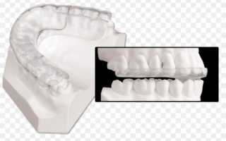 Детально о сплинт терапии в стоматологии при лечении аномалий зубочелюстного аппарата