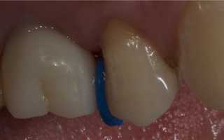 Актуальность применения сепарационных колец для коррекции прикуса в ортодонтии