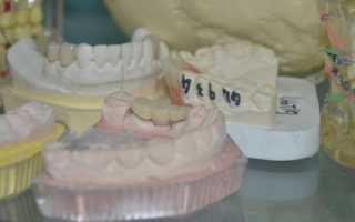 Особенности проведения сложного протезирования зубов