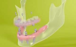 Можно ли провести имплантацию зубов без синус лифтинга