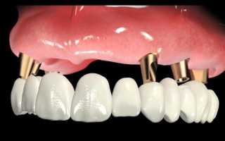 Комплексная имплантация – прогрессивный способ немедленного восстановления всех зубов