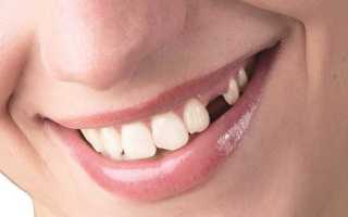 Восстановление с помощью несъемных зубных протезов при частичном отсутствии зубов