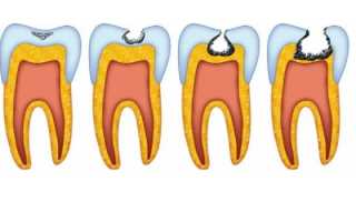 Классификация кариеса зубов по шкале Блэка