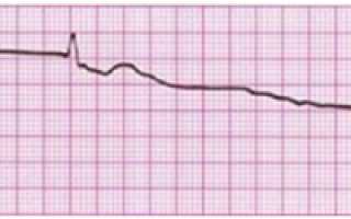 Укол в сердце: какие делают, когда делают инъекции, поможет ли внутрисердцечный прямой укол адреналина