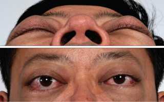 Как облегчить глазные симптомы при тиреотоксикозе