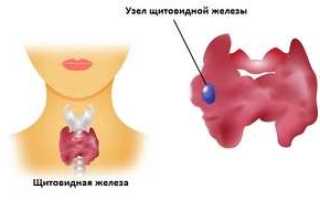 Узлы щитовидной железы на УЗИ: причины и механизм возникновения, нужно ли лечение