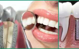 Важные аспекты методики однофазной имплантации зубов