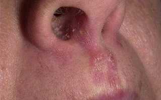 Симптомы стафилококка в носу у взрослого человека
