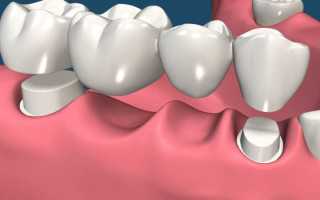 Описание различных видов зубных мостов