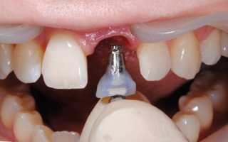 Плюсы и минусы установки импланта сразу после удаления зуба