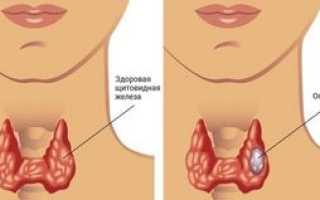 Узловые образования щитовидной железы на УЗИ: какие процессы вызывают, лечение