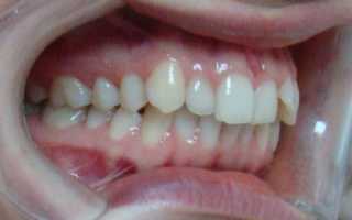 Эффективные способы коррекции вестибулярного положения зубов