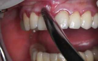 Почему возникают свищи после имплантации зубов, чем чревато, что делать?