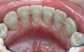 Шинирование подвижных зубов: специфика и нюансы проведения, фото «до и после»
