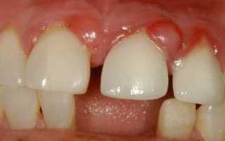 Способы лечения гранулемы зуба