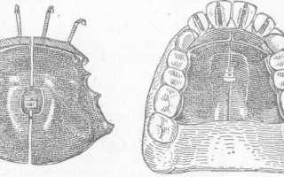 Обзор уникального комбинированного ортодонтического аппарата Хургиной