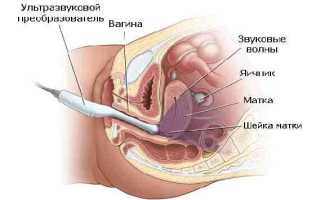 Полип эндометрия на УЗИ: можно ли увидеть, виды и признаки при сканировании