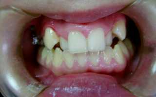 Чем опасно оральное положение зубов и как исправить ситуацию?