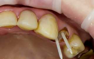 Стекловолоконный штифт в стоматологии – достойный выбор для реставрации зуба