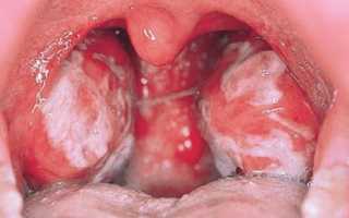 Симптомы золотистого стафилококка в горле у взрослых людей