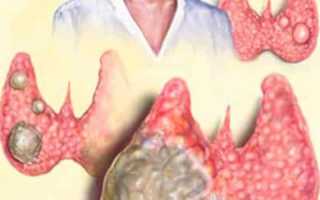 Виды и характеристика заболеваний щитовидной железы